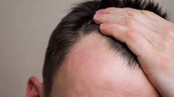 Young man checking a thinning hairline at the front scalp